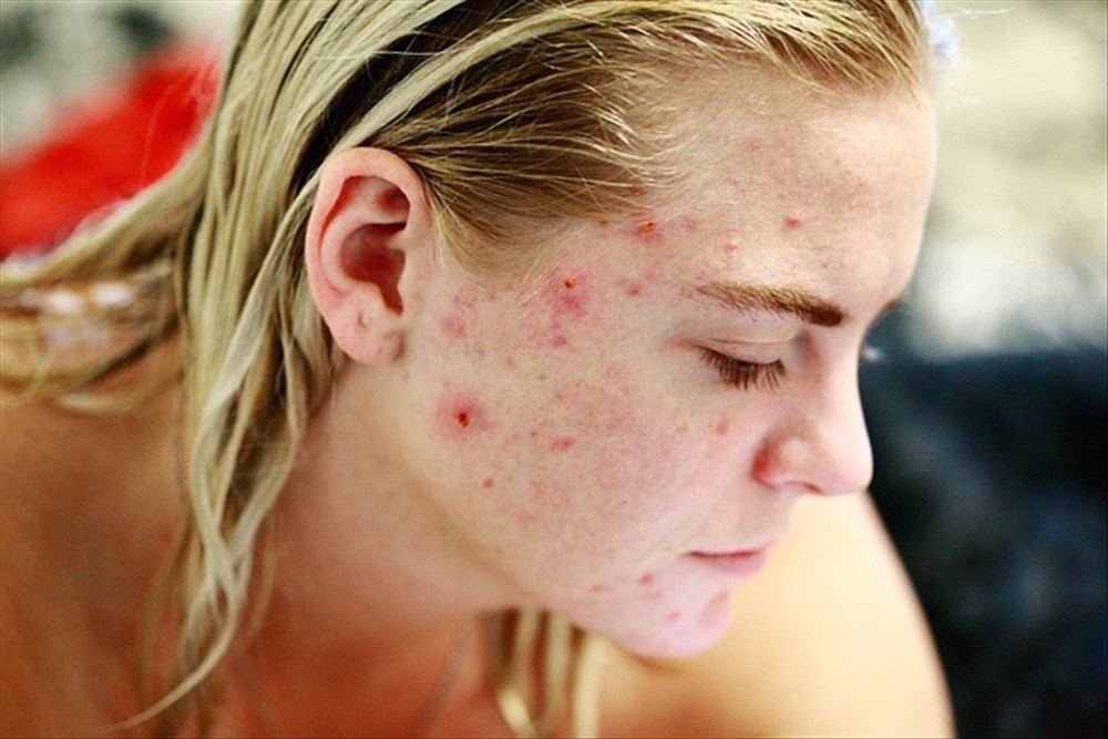 Méthodes efficaces pour traiter l'acné naturellement